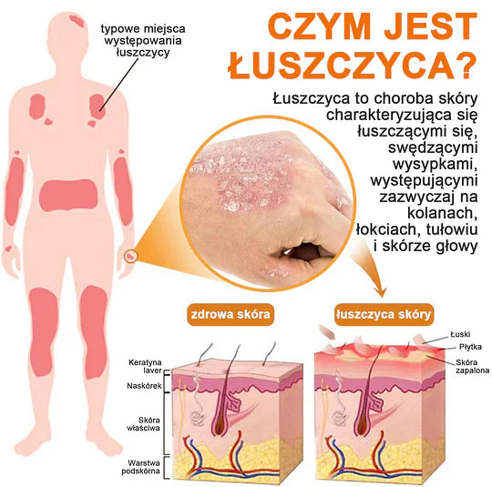 (🔥Płatność przy odbiorze🔥70% zniżki) LOVILDS™ PsoriaHeal Spray na łuszczycę (wysyłka na cały świat – bezpłatna wysyłka)🌐