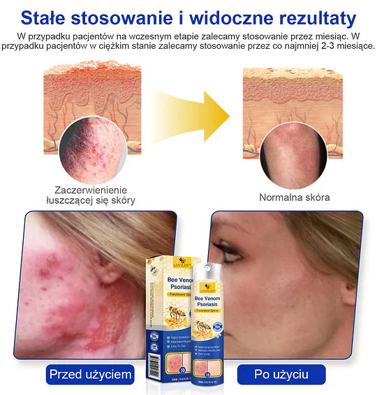 (🔥Płatność przy odbiorze🔥70% zniżki) LOVILDS™ PsoriaHeal Spray na łuszczycę (wysyłka na cały świat – bezpłatna wysyłka)🌐