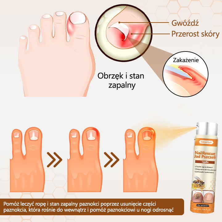 Spray z jadem pszczelim – skuteczny w leczeniu infekcji grzybiczych i zapalenia paznokci🐝