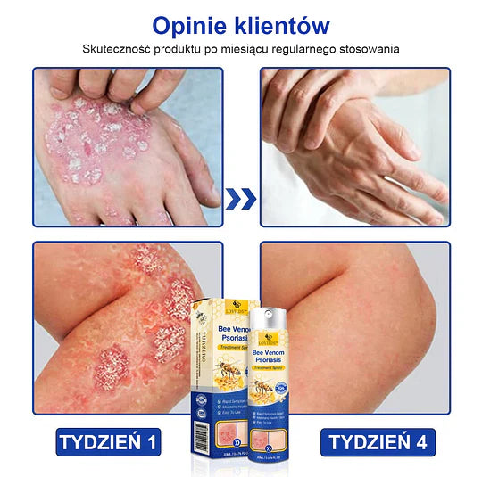 (🔥Płatność przy odbiorze🔥70% zniżki) LOVILDS™ PsoriaHeal Spray na łuszczycę (wysyłka na cały świat – bezpłatna wysyłka)🌐