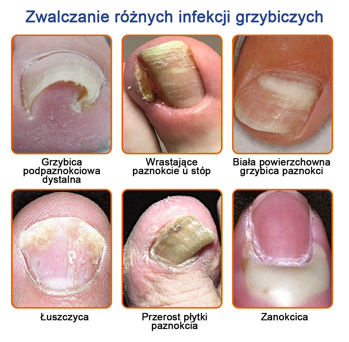 Spray z jadem pszczelim – skuteczny w leczeniu infekcji grzybiczych i zapalenia paznokci🐝