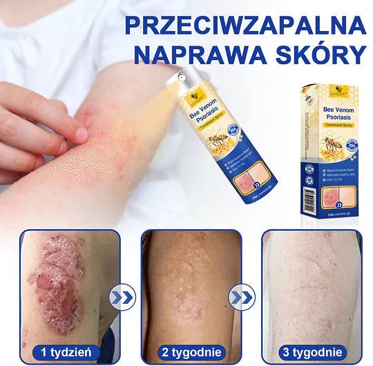 (🔥Płatność przy odbiorze🔥70% zniżki) LOVILDS™ PsoriaHeal Spray na łuszczycę (wysyłka na cały świat – bezpłatna wysyłka)🌐