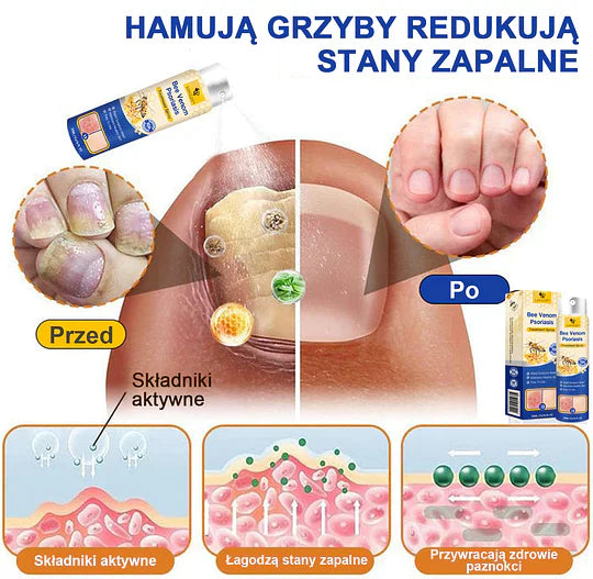 (🔥Płatność przy odbiorze🔥70% zniżki) LOVILDS™ PsoriaHeal Spray na łuszczycę (wysyłka na cały świat – bezpłatna wysyłka)🌐