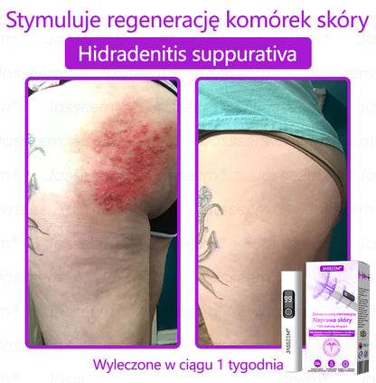 🔥𝐉𝐚𝐬𝐬𝐞𝐞𝐦® Zaawansowany nieinwazyjny laser CO₂ do naprawy skóry 🎉 (Delikatnie usuwa brodawki, znamiona, plamy starcze i narośla skórne – bez bólu, bez zamieszania!)