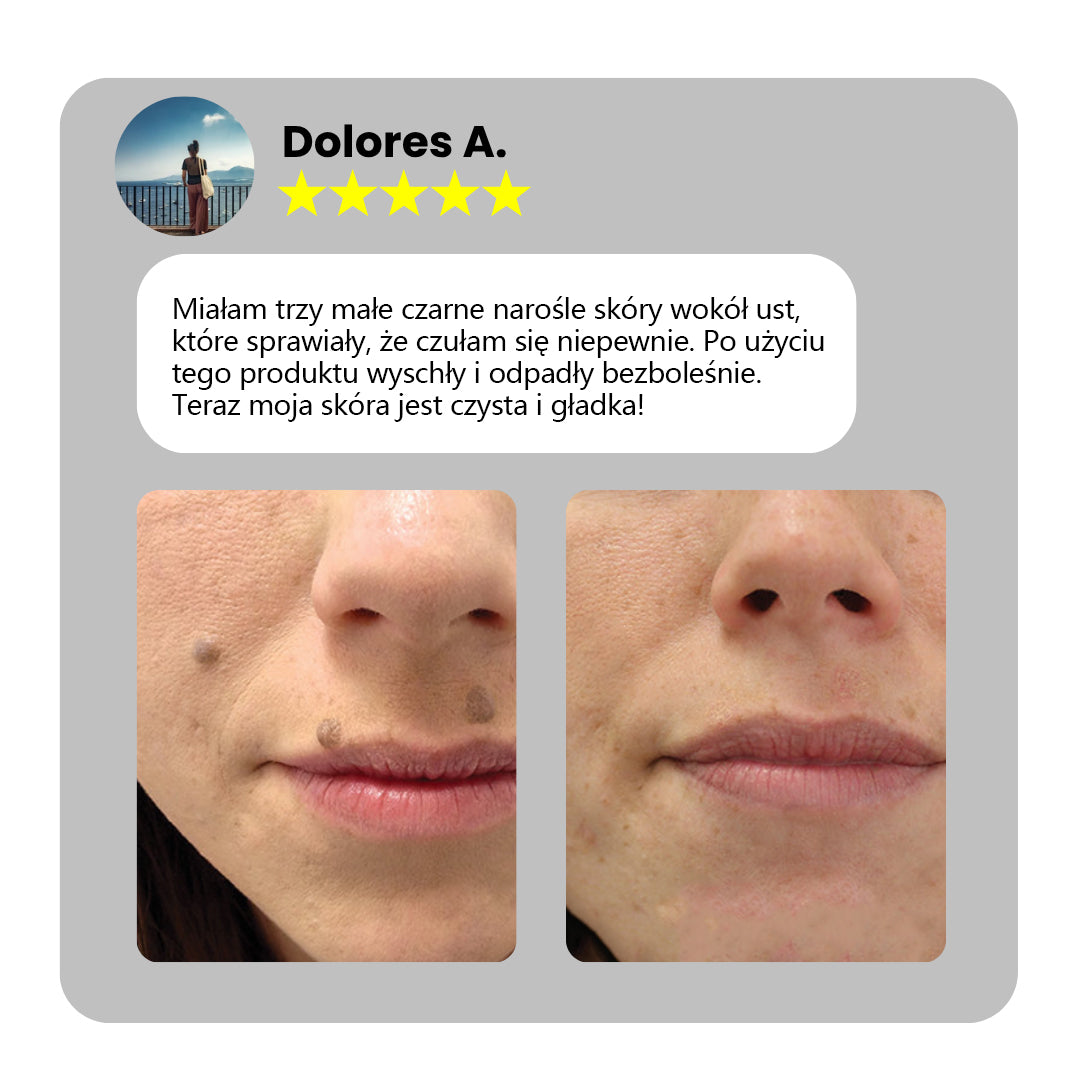 ✅Bikenda® do użytku domowego CO2 Laser Shot Erase Pro