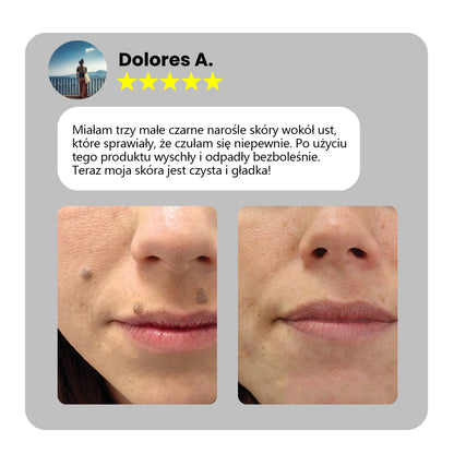 ✅Bikenda® do użytku domowego CO2 Laser Shot Erase Pro