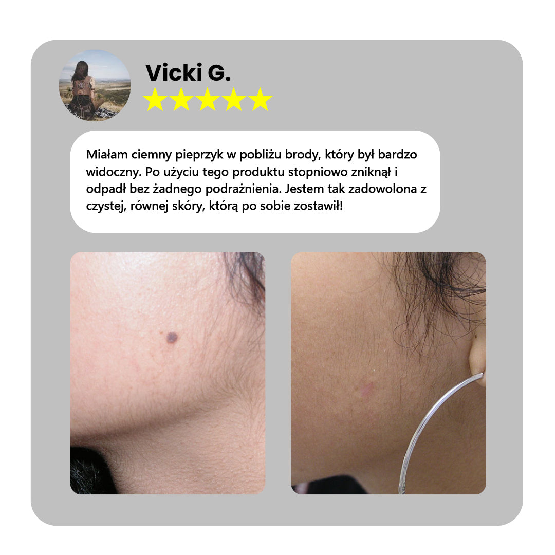 ✅Bikenda® do użytku domowego CO2 Laser Shot Erase Pro