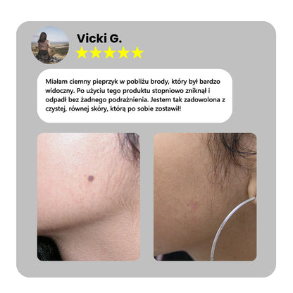 ✅Bikenda® do użytku domowego CO2 Laser Shot Erase Pro