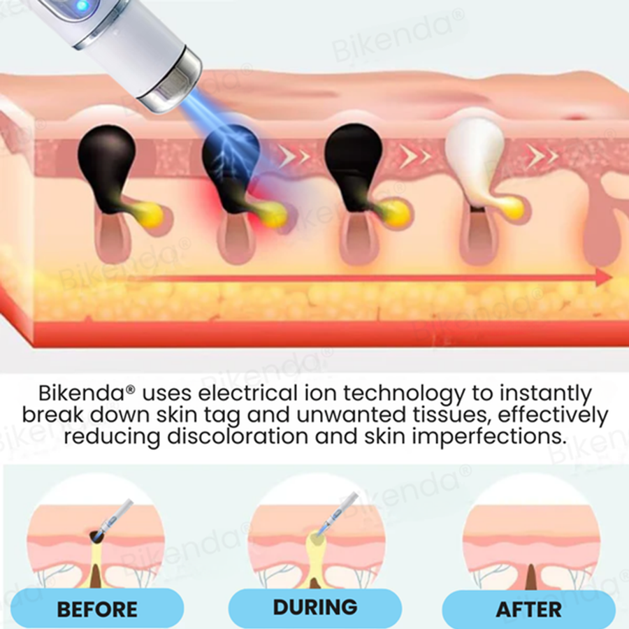 Bikenda®Nieinwazyjny laser do usuwania znamion i brodawek