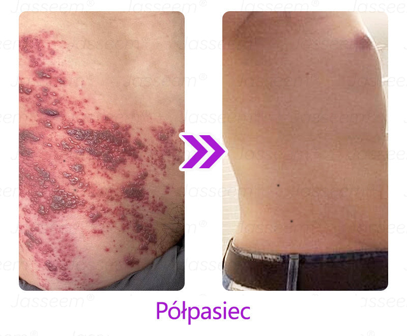 🔥𝐉𝐚𝐬𝐬𝐞𝐞𝐦® Zaawansowany nieinwazyjny laser CO₂ do naprawy skóry 🎉 (Delikatnie usuwa brodawki, znamiona, plamy starcze i narośla skórne – bez bólu, bez zamieszania!)