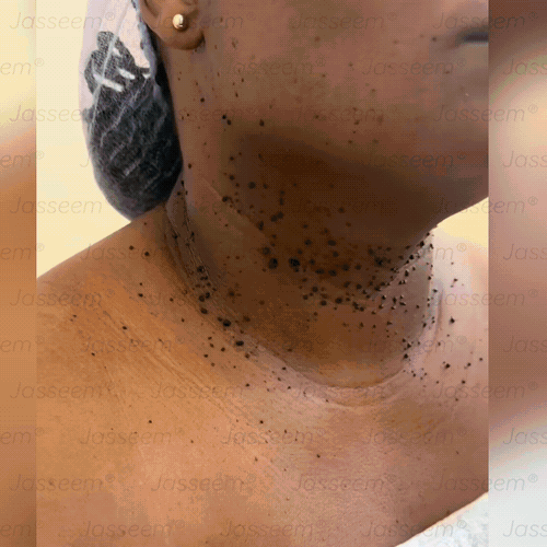 🔥𝐉𝐚𝐬𝐬𝐞𝐞𝐦® Zaawansowany nieinwazyjny laser CO₂ do naprawy skóry 🎉 (Delikatnie usuwa brodawki, znamiona, plamy starcze i narośla skórne – bez bólu, bez zamieszania!)