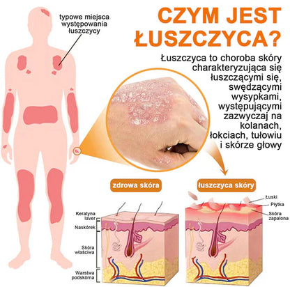 (🔥Płatność przy odbiorze🔥70% zniżki) LOVILDS™ PsoriaHeal Spray na łuszczycę (wysyłka na cały świat – bezpłatna wysyłka)🌐