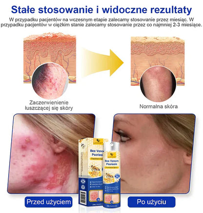 (🔥Płatność przy odbiorze🔥70% zniżki) LOVILDS™ PsoriaHeal Spray na łuszczycę (wysyłka na cały świat – bezpłatna wysyłka)🌐