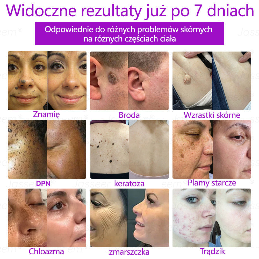 🔥𝐉𝐚𝐬𝐬𝐞𝐞𝐦® Zaawansowany nieinwazyjny laser CO₂ do naprawy skóry 🎉 (Delikatnie usuwa brodawki, znamiona, plamy starcze i narośla skórne – bez bólu, bez zamieszania!)