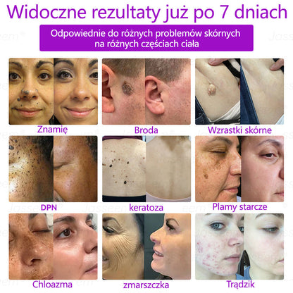 🔥𝐉𝐚𝐬𝐬𝐞𝐞𝐦® Zaawansowany nieinwazyjny laser CO₂ do naprawy skóry 🎉 (Delikatnie usuwa brodawki, znamiona, plamy starcze i narośla skórne – bez bólu, bez zamieszania!)