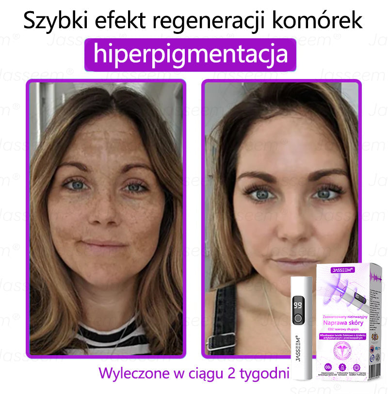 🔥𝐉𝐚𝐬𝐬𝐞𝐞𝐦® Zaawansowany nieinwazyjny laser CO₂ do naprawy skóry 🎉 (Delikatnie usuwa brodawki, znamiona, plamy starcze i narośla skórne – bez bólu, bez zamieszania!)