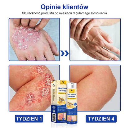 (🔥Płatność przy odbiorze🔥70% zniżki) LOVILDS™ PsoriaHeal Spray na łuszczycę (wysyłka na cały świat – bezpłatna wysyłka)🌐