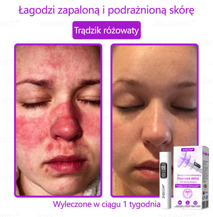 🔥𝐉𝐚𝐬𝐬𝐞𝐞𝐦® Zaawansowany nieinwazyjny laser CO₂ do naprawy skóry 🎉 (Delikatnie usuwa brodawki, znamiona, plamy starcze i narośla skórne – bez bólu, bez zamieszania!)
