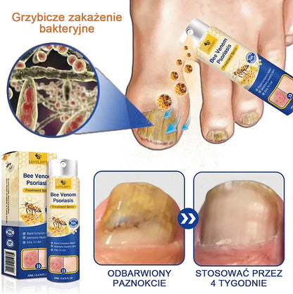 (🔥Płatność przy odbiorze🔥70% zniżki) LOVILDS™ PsoriaHeal Spray na łuszczycę (wysyłka na cały świat – bezpłatna wysyłka)🌐